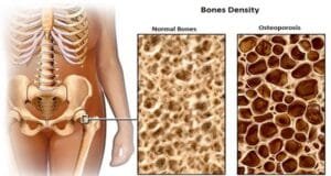 3 Secret Foods That Crush Osteoporosis and Fortify Your Bones