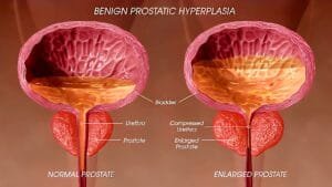 Worried about an enlarged prostate?