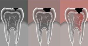 How to Restore Rotten Teeth & Gums: What Really Works (Backed by Science) 2 75250